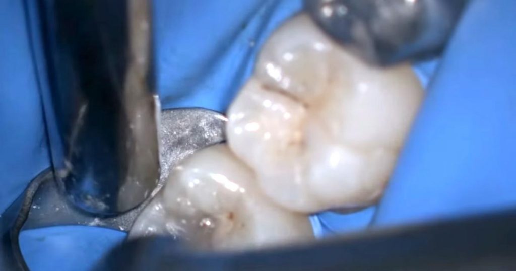 小さな虫歯だと思ったのに、、歯医者に行こうと思わせられる動画が話題に！「ちょっと歯磨きしてくる」「歯医者行かなきゃ。。」の声