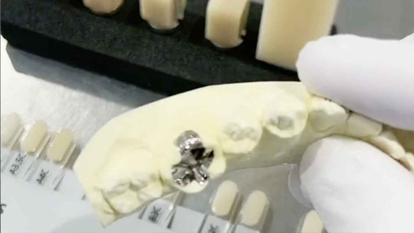 銀歯アリの人に朗報！白い歯が2022年4月より保険適用されていた！